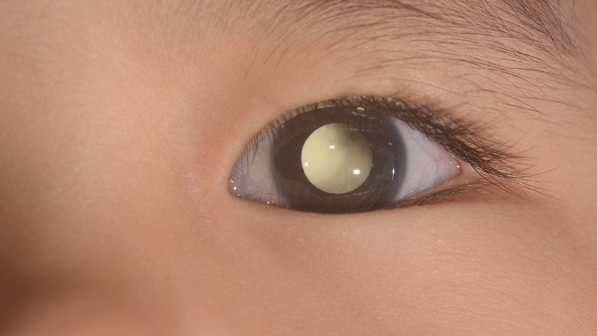 Retinoblastoma: a importância da saúde ocular
