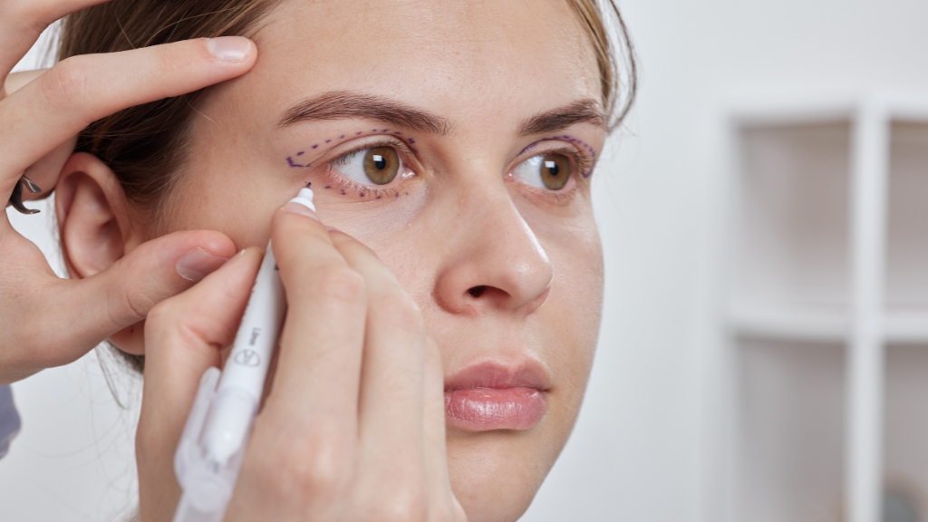 Blefaroplastia