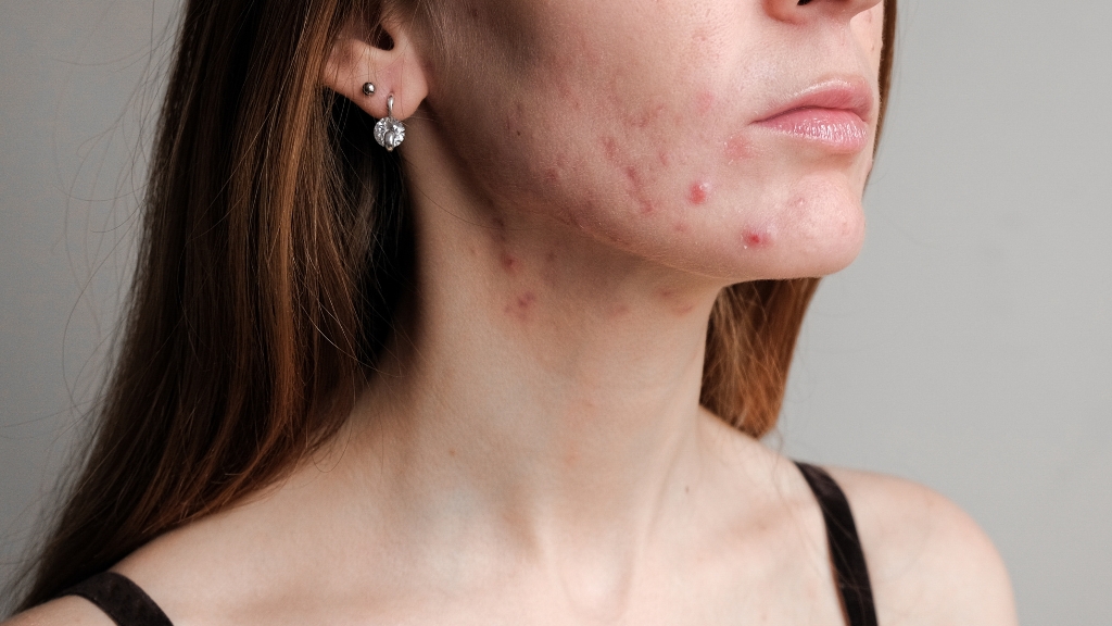 Acne